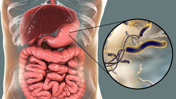 Test) en aliento para Diagnosticar infección por H.pylori