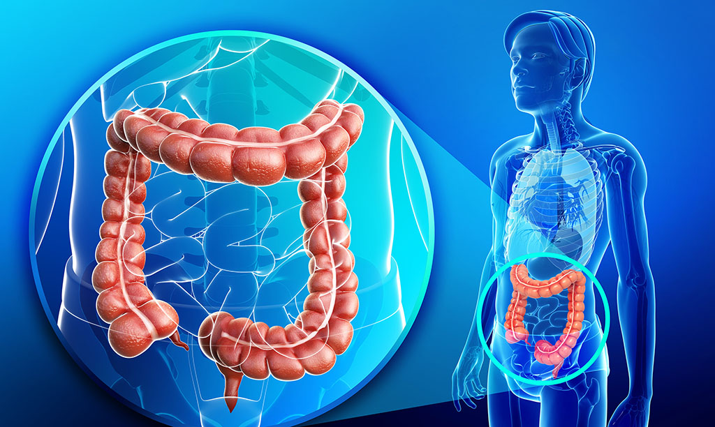 Roughly 140,000 people are diagnosed with colorectal cancer in the United States each year. (Fotolia)