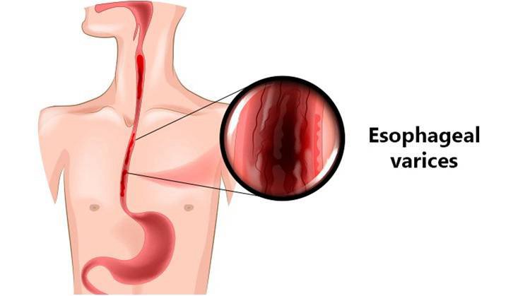 esophageal-varices